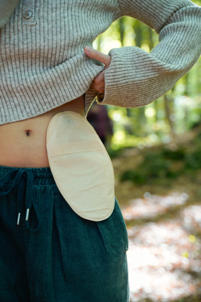 A female shows off her ostomy bag on her stomach. She's an ostomate. This is someone who's undergone ostomy or stoma surgery in order to fix her IBD. 